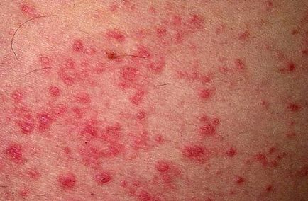 Dermatitis (fotók) - Tünetek és kezelés Felnőttek