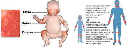 Photo dermatitisz gyermek, felnőtt, láb, arc