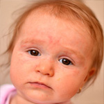 Photo dermatitisz gyermek, felnőtt, láb, arc