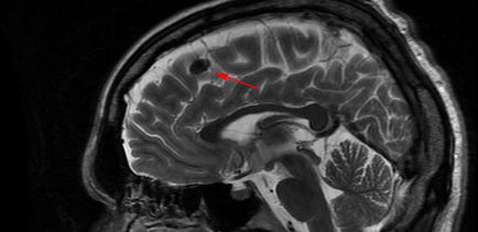 Egyes sérülések a fehérállomány az agy - az eredmények MRI