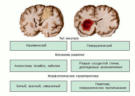 Vérzéses agyi stroke tüneteinek, hatások és a kezelés
