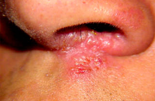 Herpes az orrát - okok és gyors kezelést otthon