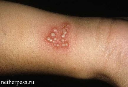 Herpes kézen diagnózis, tünetek, kezelés