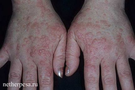 Herpes kézen diagnózis, tünetek, kezelés