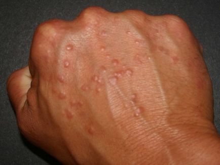 Herpes kézen kezelések, okai és tünetei a vírus
