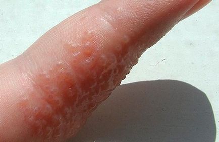 Herpes kézen okok, tünetek (fotó), hogyan lehet megszabadulni