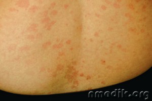 Gombás betegségek a bőr - tünetek és kezelés