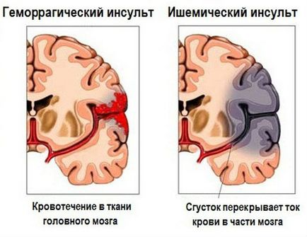A jobb agyfélteke agyvérzés következményeinek - a szív-