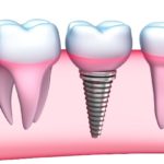 Izraeli implantátumok alfa - bio - előnyök és hátrányok, ár, vélemények