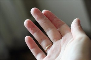 Ez az, amiért a bőr kifejtve a kézen