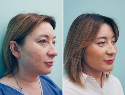 Hogyan változtassuk meg, hogy valaki vonzóbb, ha lehet teljesen megváltoztatni az arcát plasztikai