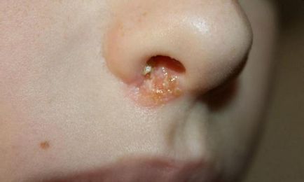 Hogyan kell kezelni a herpesz vírus elleni kenőcs az orr
