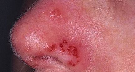 Hogyan kell kezelni a herpesz vírus elleni kenőcs az orr