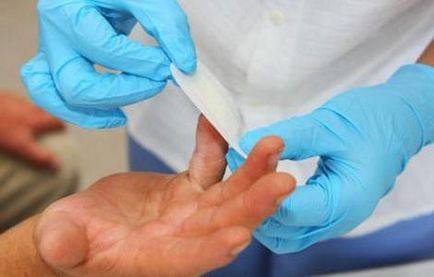 Hogyan kell kezelni hólyagok ujjait a különböző terápiák