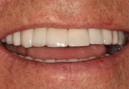 Hogyan növeli az árat az elülső fogak, és hogy lehetséges-e, hogy fáj