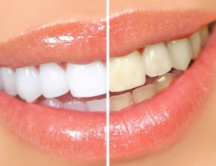 Hogyan fehéríti a fogakat, aktív szénnel