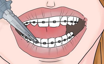 Mivel a fogakról melles funkciók és ellátás után az eljárás