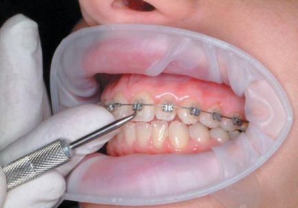 Mivel a fogakról melles funkciók és ellátás után az eljárás