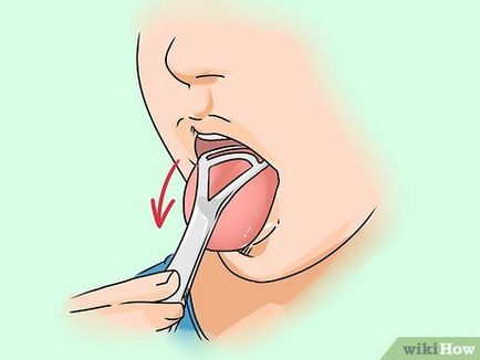 Hogyan lehet eltávolítani a fehér bevonat a nyelv