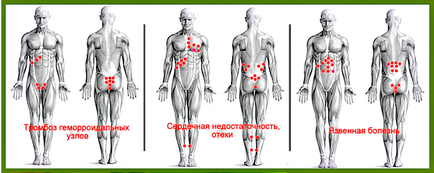 Hirudotherapy pióca terápia otthon