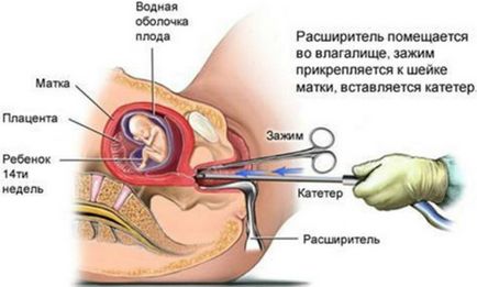 Havonta az abortusz után, amikor jönnek, hogy mi ez attól függ, mértéke, kóros állapotok