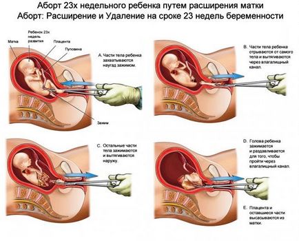 Hónapról abortusz (vetélés) - indításakor, jön, hogy miért nem, a