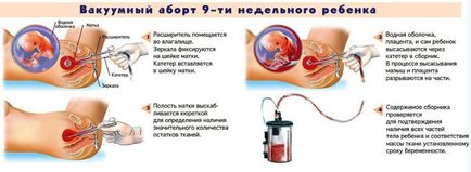 Hónapról abortusz (vetélés) - indításakor, jön, miért nem, a (abortusz) Hónapról abortusz (vetélés) - indításakor, jön, hogy miért nem, a