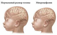 Microcephalia - okai, tünetei, diagnózisa és kezelése