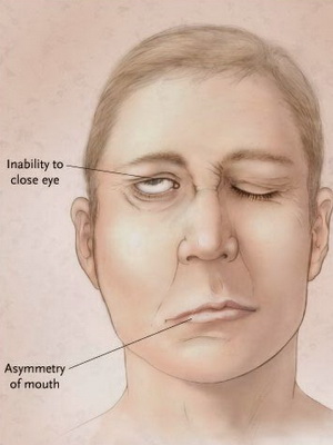 Ideggyulladás az arcideg tünetei, kezelése és fotót Bell-féle bénulás, torna ideggyulladásnál a facialis