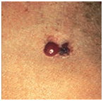 Veszélyes 6 mol jelek melanoma