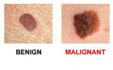 Veszélyes 6 mol jelek melanoma