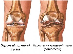 a térd osteophytes diagnózis és kezelés