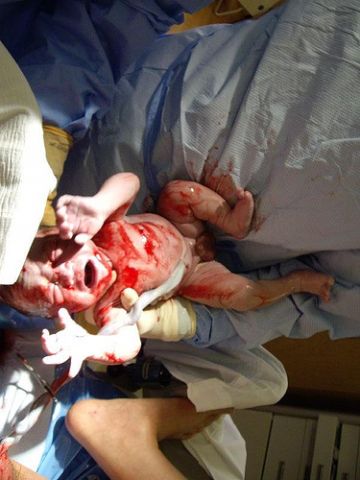 Ahol a gyerekek másznak születéskor fotó, baba születése