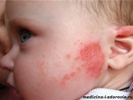 Élelmiszer allergia gyermekeknél, okok, tünetek, kezelés