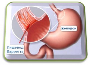 Barrett-nyelőcső tünetek, kezelés, diéta, műtét