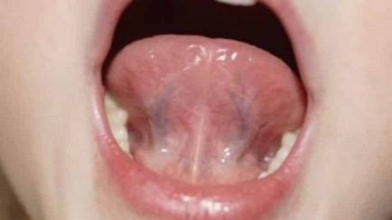 Miért fáj a kantár a nyelv alá