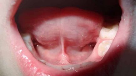 Miért fáj a kantár a nyelv alá