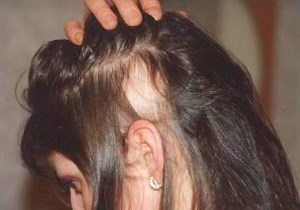 Sok haj hullik ki - lehetséges okok és kezelések hajhullás