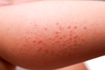Típusai és jellemzői a használata antiallergiás kenőcsök