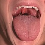 Gyulladás a szájnyálkahártya és a nyelv