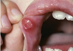 betegségek a szájüreg, a nyálkahártya és a nyelv felnőtteknél fotó kezelési