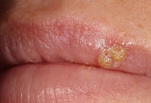 betegségek a szájüreg, a nyálkahártya és a nyelv felnőtteknél fotó kezelési