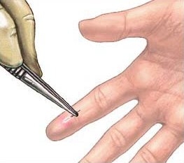 Splinter tünetek, mit kell tenni, ha egy szilánk az ujját