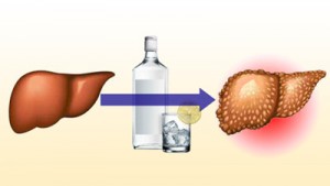 Alkoholos cirrhosis tünetei, a kezelés és a prognózis