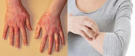Allergia háztartási vegyszerek okoz, tünetei, kezelése