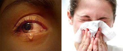 Allergiás a fahéj tünetek, kezelés