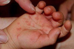 Allergiás a tenyéren az okok és a kezelés