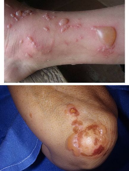 Hólyagos dermatitis patológia besorolás, okok és a tünetek, a kezelés elveit, fotók