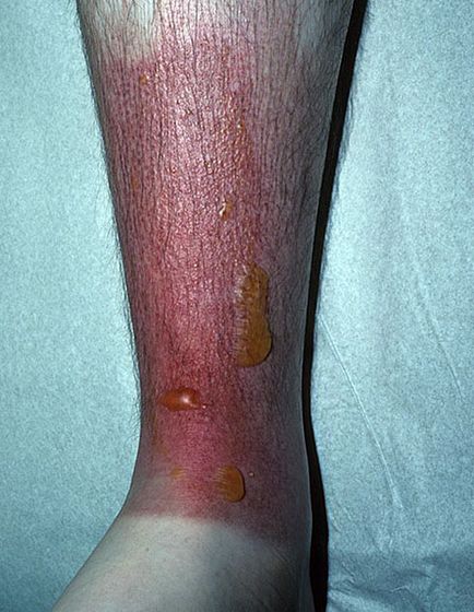 Hólyagos dermatitis patológia besorolás, okok és a tünetek, a kezelés elveit, fotók