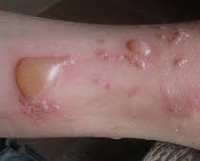 Hólyagos dermatitis - okai, tünetei, diagnózisa és kezelése